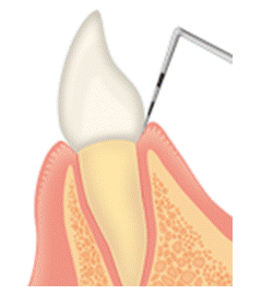 歯周病の進行状況の確認